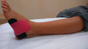 Imagen de una aplicación de Kinesiotaping con material BC KinTape en una fractura de metatarsiano